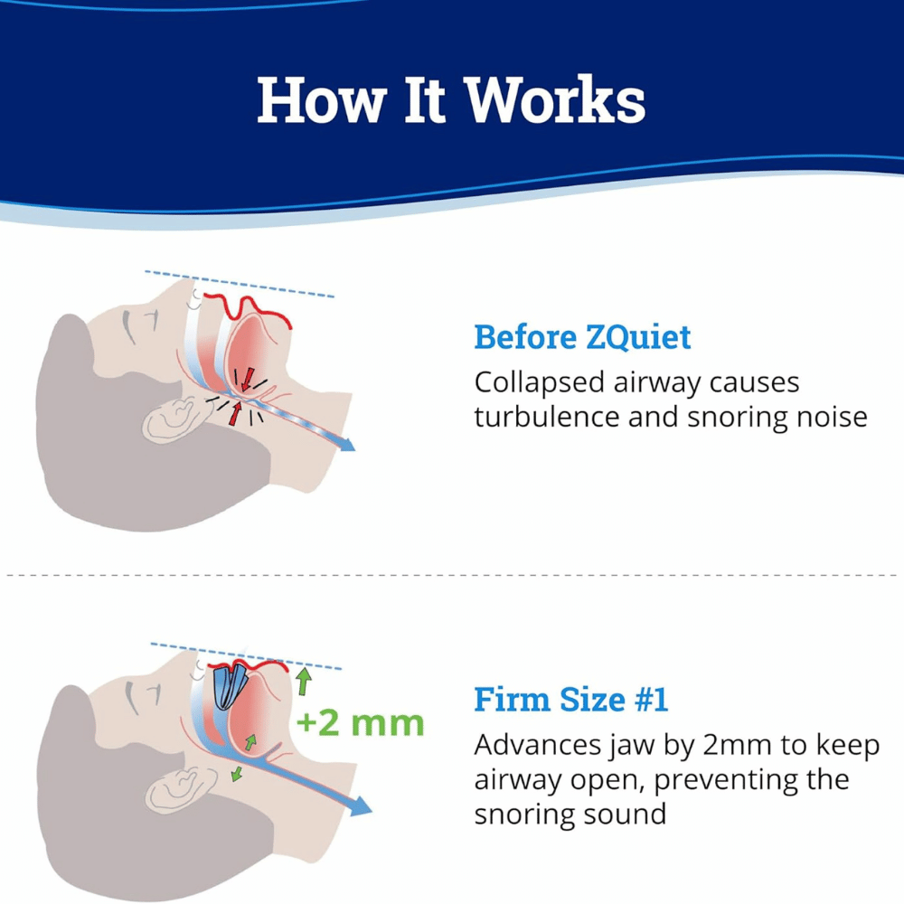 ZQuiet Anti-Snoring Mouthpiece